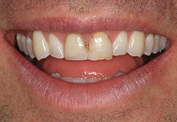 Damaged teeth and gums before cosmetic dentistry