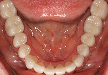 Healthy teeth and gums after cosmetic dentistry