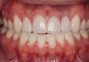Healthy teeth and gums after cosmetic dentistry