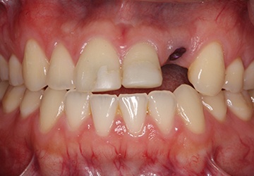 Damaged teeth and gums before cosmetic dentistry