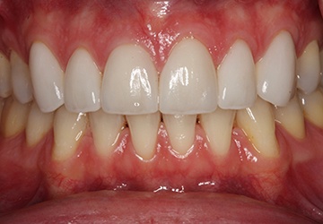 Healthy teeth and gums after cosmetic dentistry