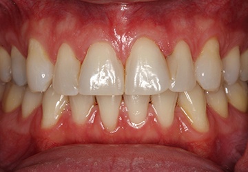 Damaged teeth and gums before cosmetic dentistry