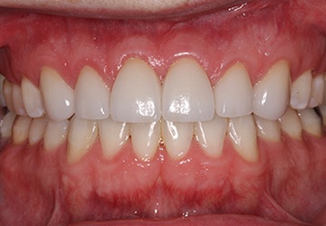Healthy teeth and gums after cosmetic dentistry