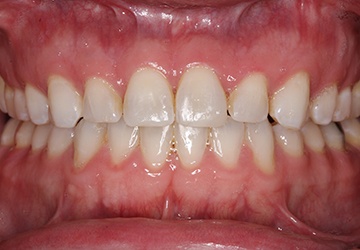 Damaged teeth and gums before cosmetic dentistry