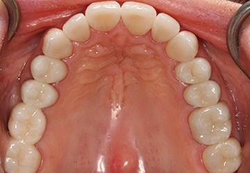 Healthy teeth and gums after cosmetic dentistry