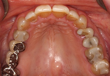 Damaged teeth and gums before cosmetic dentistry