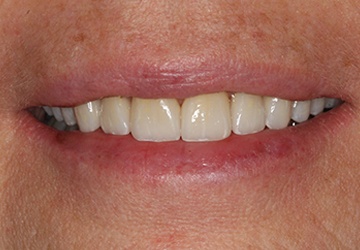 Healthy teeth and gums after cosmetic dentistry