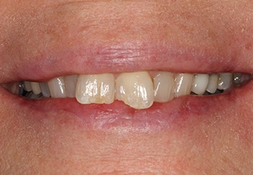 Damaged teeth and gums before cosmetic dentistry