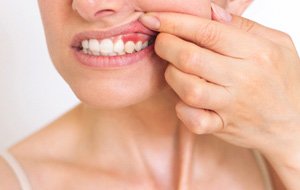Closeup of patient with red, inflamed gums