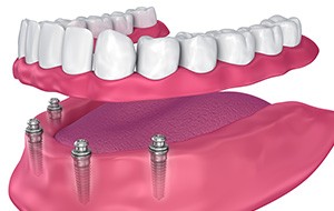 Animated implant denture