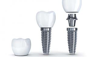 the three parts of a dental implant