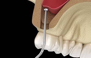 model of a sinus lift