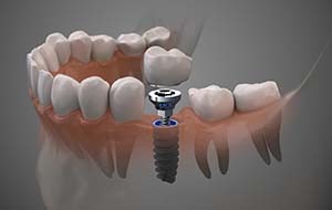 model of a single dental implant with a crown