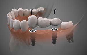 model of two implants with a bridge