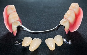 Implant retained partial dentures