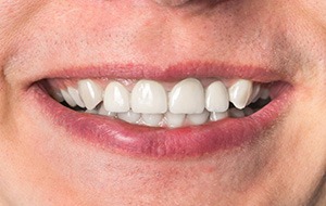 Closeup of natural looking implant denture