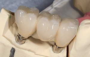Closeup of model with implant fixed bridge