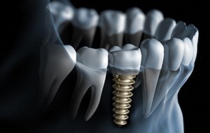 Animatino of implant supported dental crown