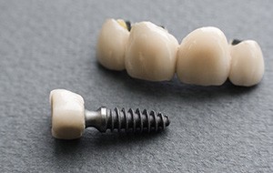 Implant crown and bridge