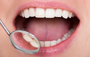Closeup of smile during dental exam