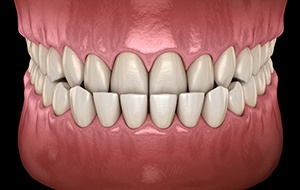 Illustration of an underbite