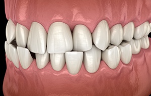 Illustration of a crossbite