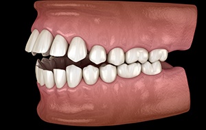 Illustration of an open bite