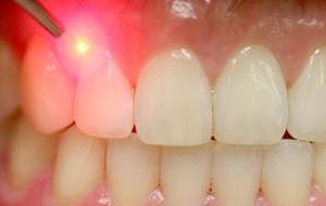 Patient receiving soft tissue laser treatment