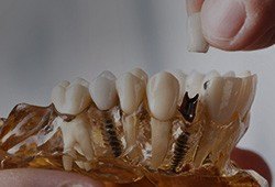 Model of dental implant supported replacement tooth