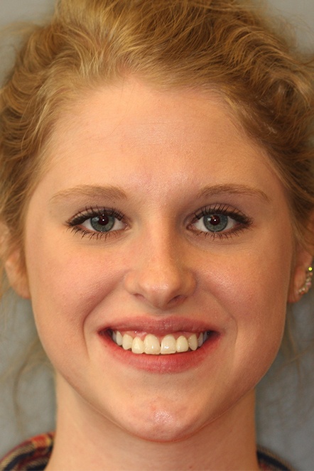 Woman's yellow colored smile before treatment