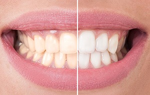 Closeup of smile half before and half after teeth whitening