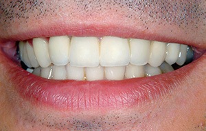 Closeup of health aligned smile after TMJ therapy