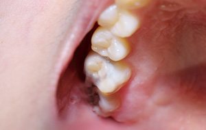 Closeup of tooth repaired with tooth-colored fillings