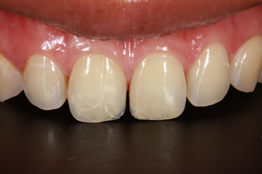 Repair Chipped Teeth With Bonding