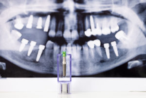 dental implants