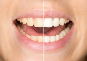 Here’s more information about teeth whitening in Lincoln.