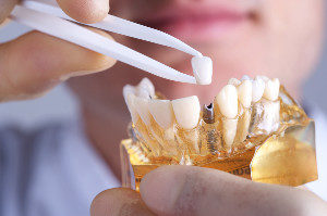 dental-implants-in-lincoln