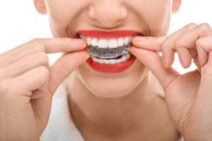 Why should I get Invisalign in Lincoln?