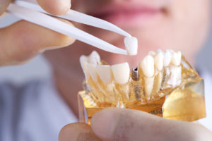 Dental implants in Lincoln support full or partial dentures