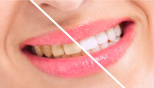 Your Lincoln dentist crafts customized whitening trays