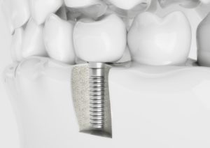 dental implant screwed into jawbone