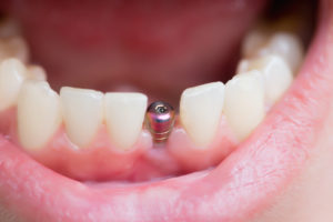 single tooth implant