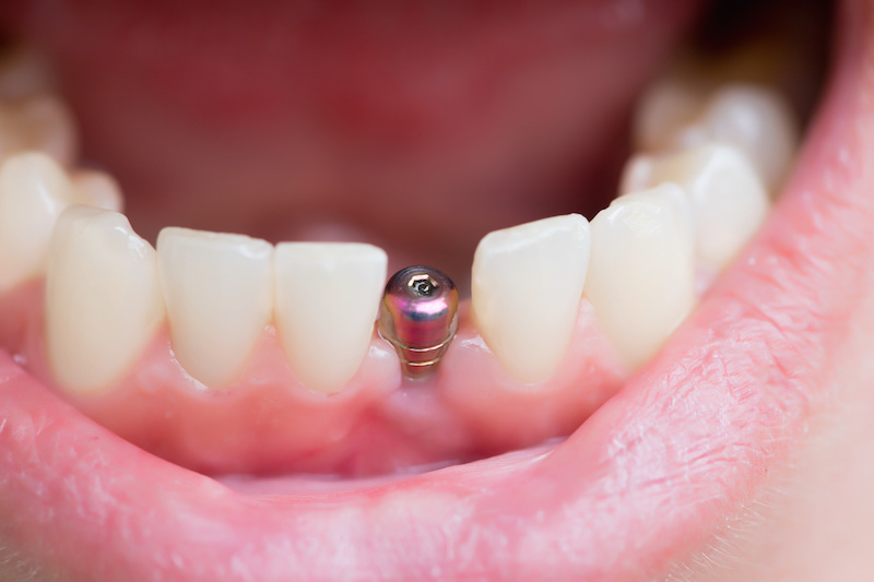 What’s the Cost of Dental Implants? Dentist in Lincoln Answers