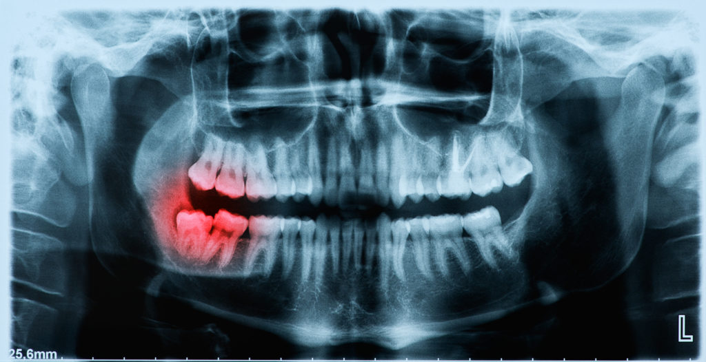 Panoramic X Ray Image Of Teeth And Mouth With Wisdom Teeth Olberding