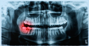 x-ray image of infected tooth