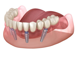 Graphic showing All-on-4 dental implants in Lincoln