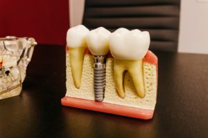 Dentist for dental implants in Lincoln. 