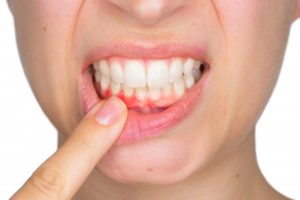 woman dealing with gingivitis closeup 