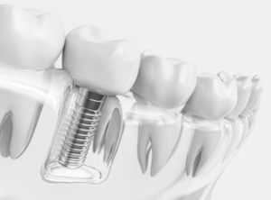 Dental implant next to other teeth in a plastic tray