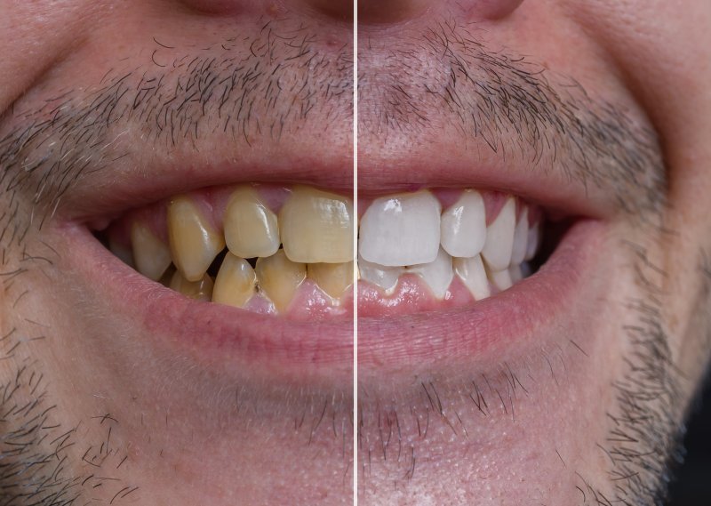 before and after picture of a man with a yellow smile